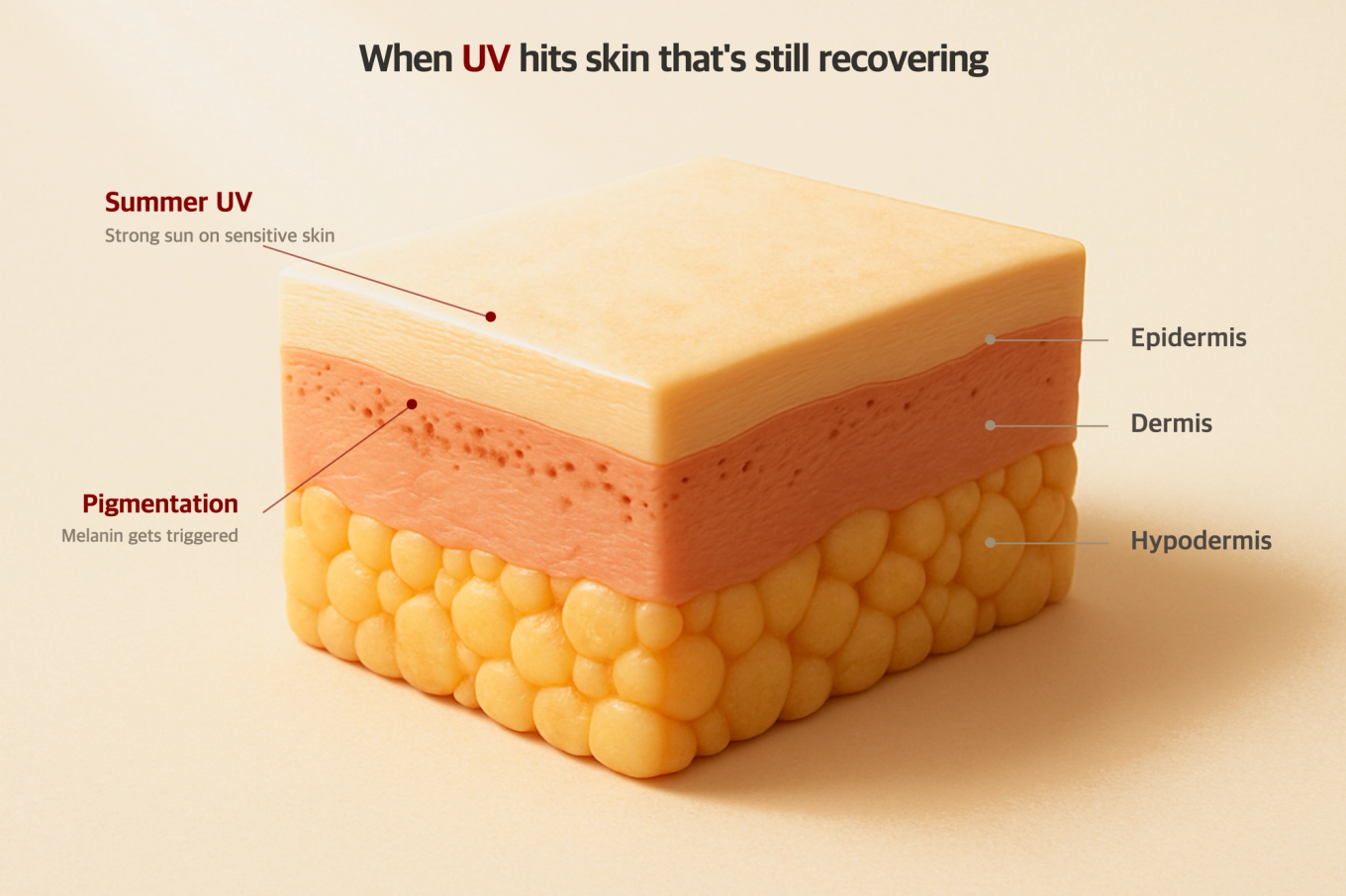 How Summer UV Rays Cause Hyperpigmentation in Recovering Skin
