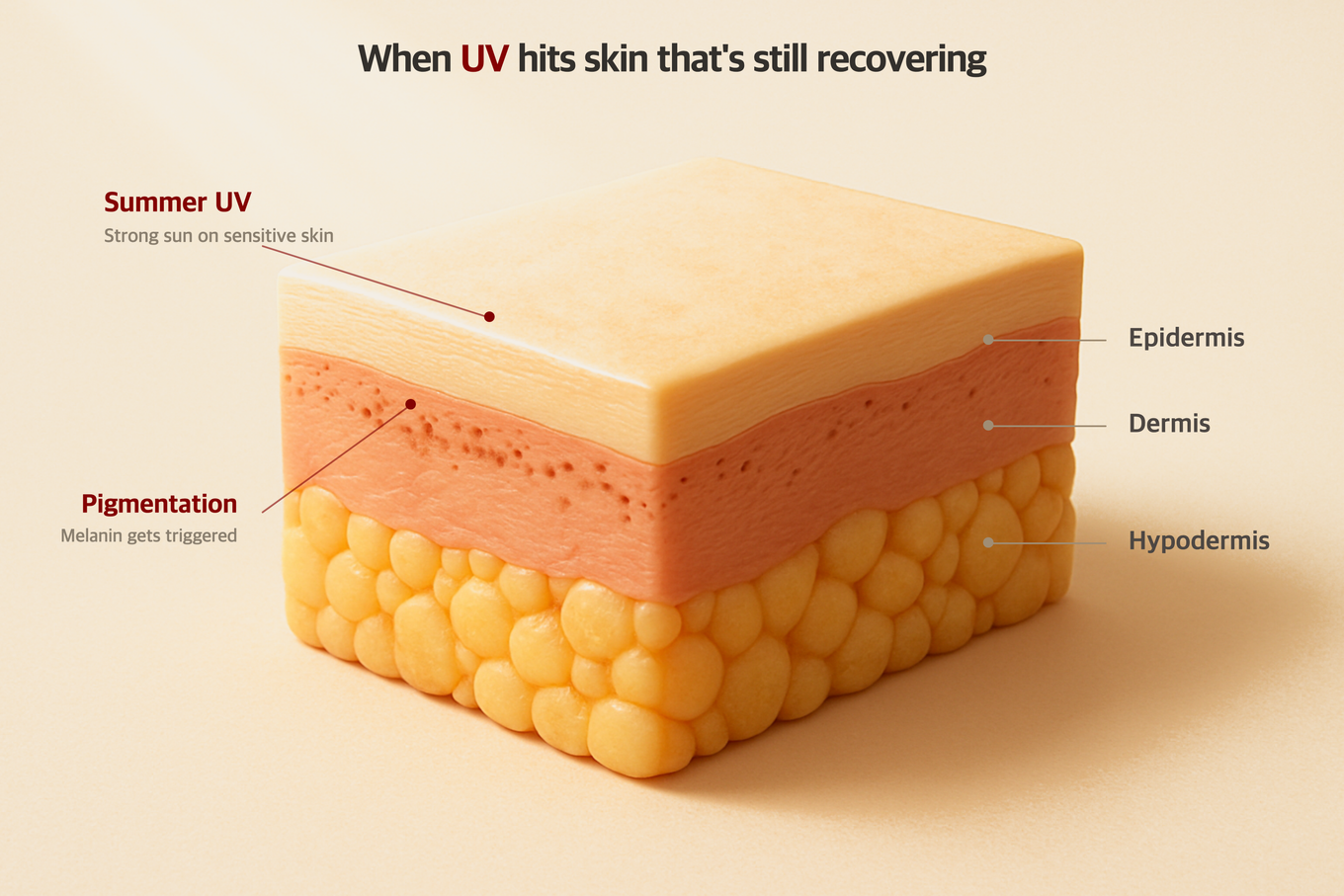 How Summer UV Rays Cause Hyperpigmentation in Recovering Skin