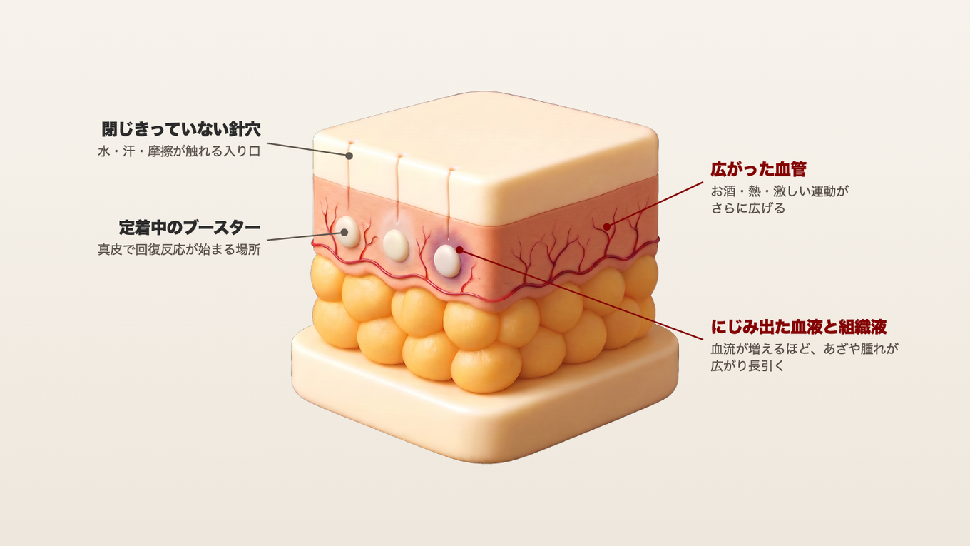 閉じきっていない針穴、なじんでいく途中のブースター、広がった血管、にじみ出た血液が回復中の真皮に同時にある様子