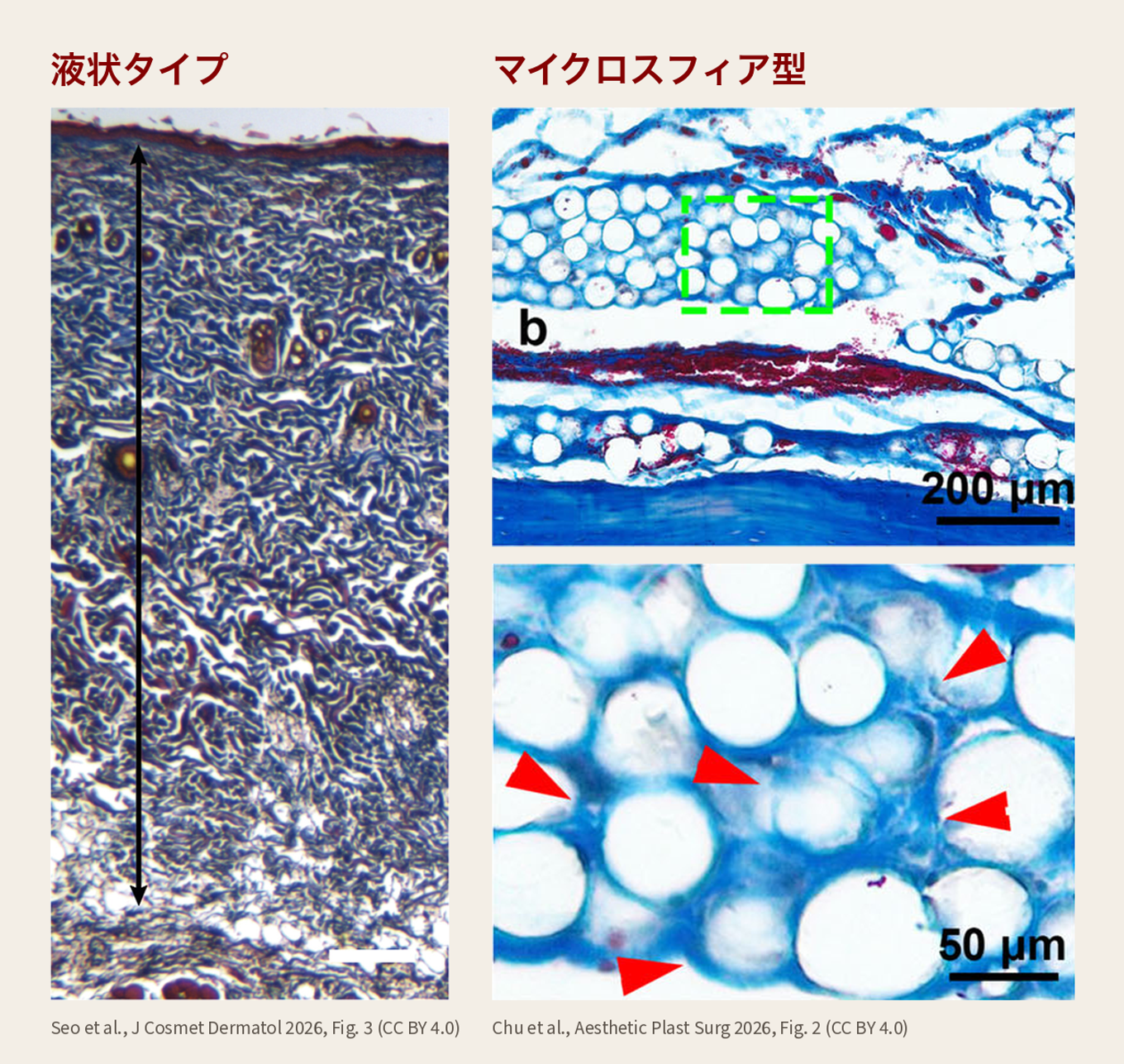 論文の組織写真2枚を並べたもので、左の液状PCLを注入した真皮の写真では丸い粒子は見られずコラーゲンが真皮に広がって見え、右のマイクロスフィア型PCLフィラーの写真では丸い微小球体が集まり、その周りにコラーゲン線維が見られる