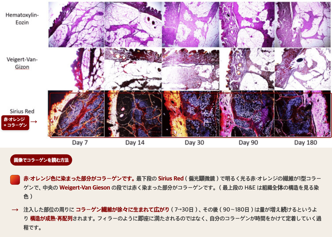 ポリ-L-乳酸(PLLA)コラーゲン刺激剤を注入した肌組織を、7・14・30・90・180日目に採取した組織学写真 - 最下段のSirius Red染色で赤・オレンジ色に光る部分が新しく生成されたコラーゲンで、時間とともに注入部位の周囲へ広がっていく