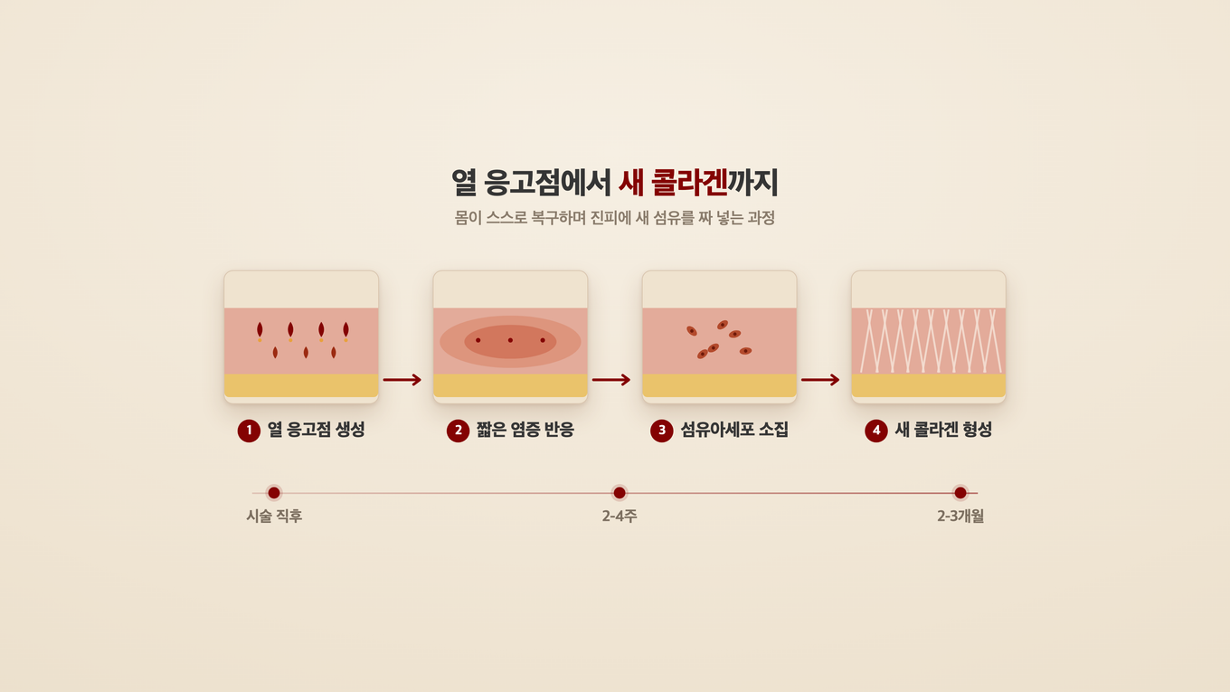열 응고점이 생기면 섬유아세포가 모여 몇 주에서 몇 달에 걸쳐 새 콜라겐을 짜 넣는다