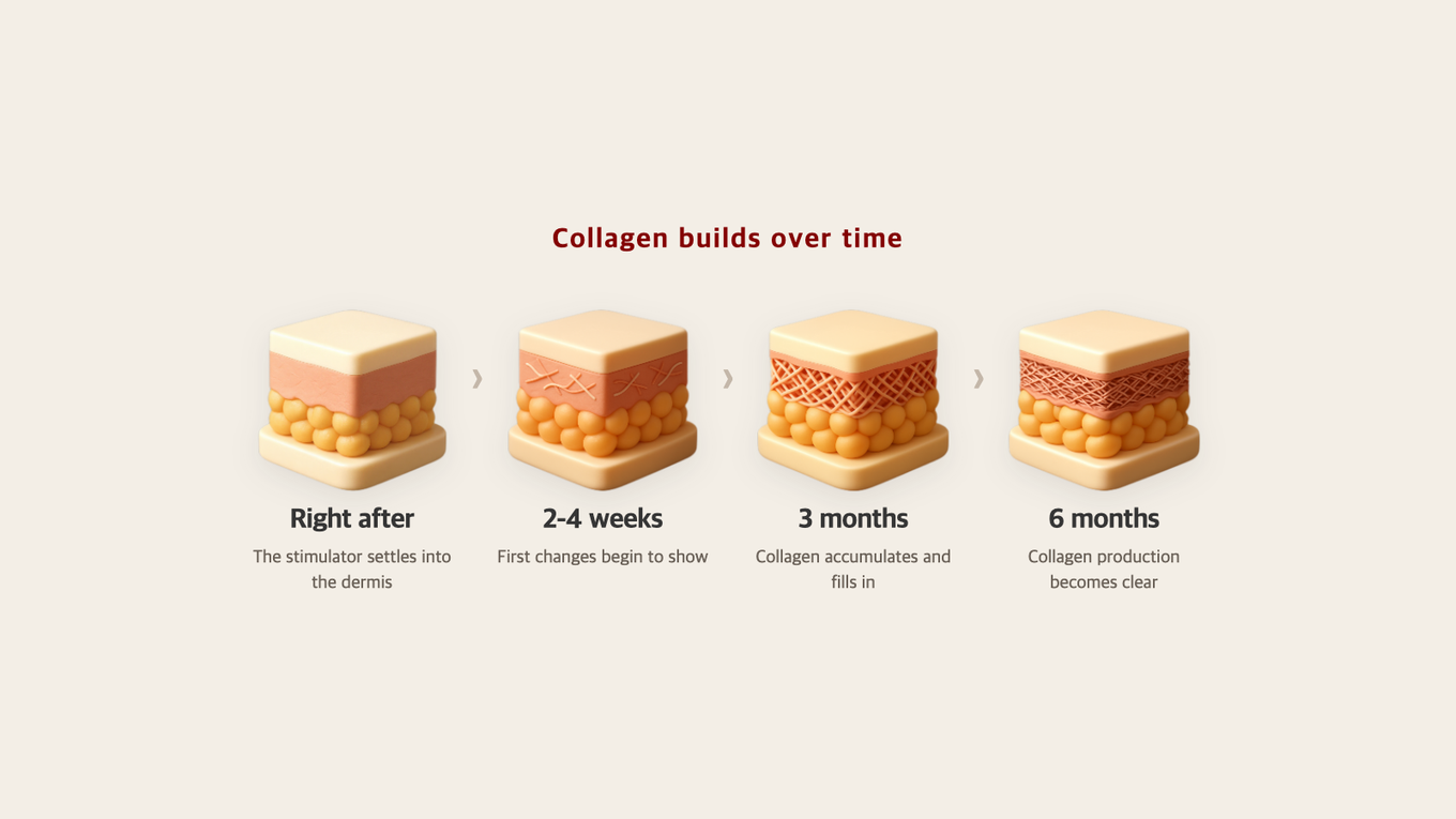 Four stages of a dermis cross-section, from right after the injection to six months, with collagen filling in step by step over time