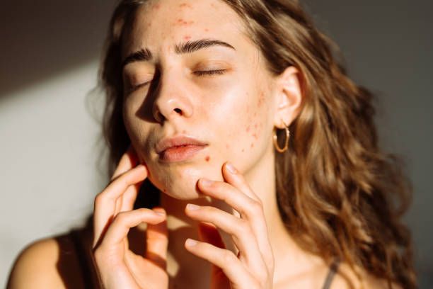 Acne