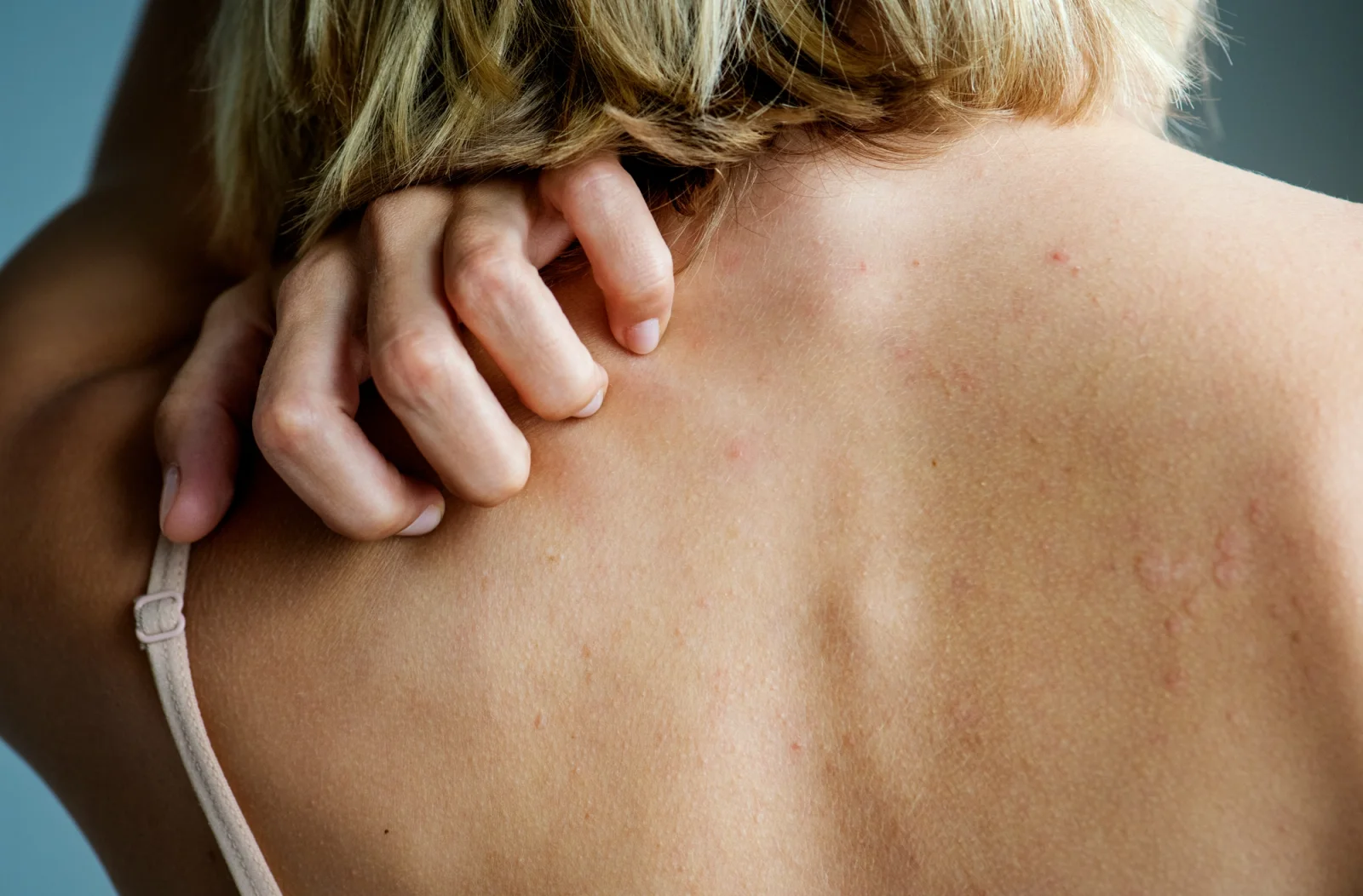 Awareness campaign that makes itching easier to talk about