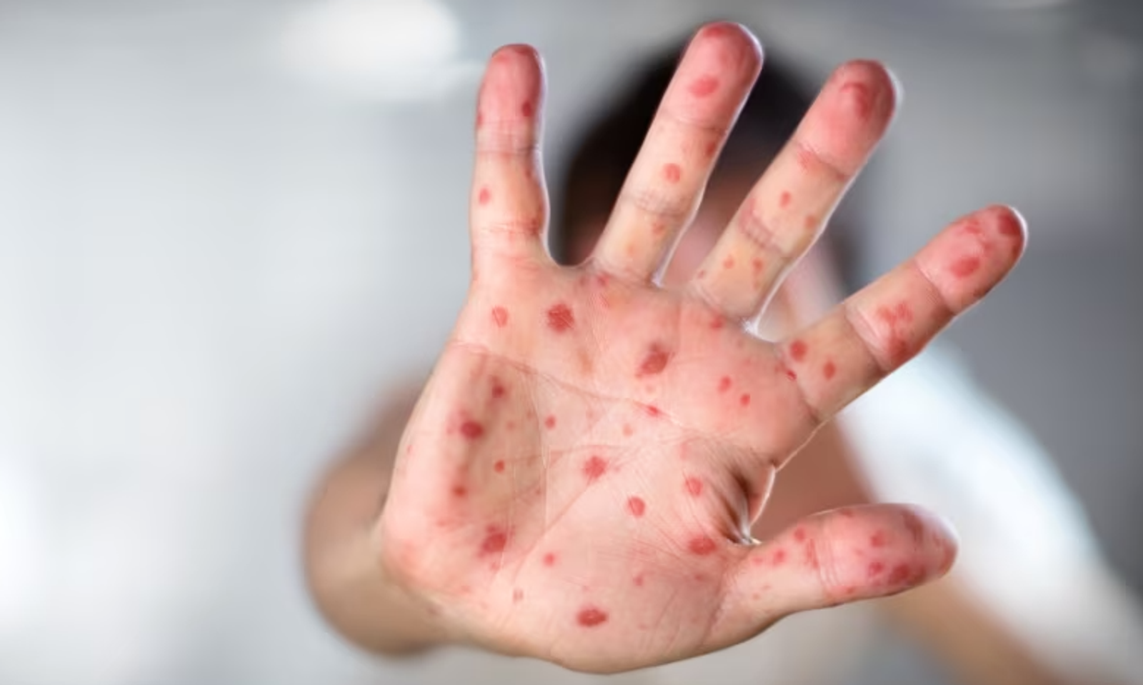 Бишкек: Кызылча оорусу менчик мектеп, бакчаларда катталды