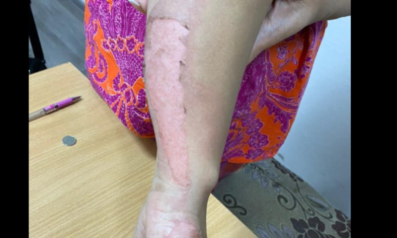 Бишкекте сабап, колуна үтүк басып, зордуктаган эркекти аял кечирди