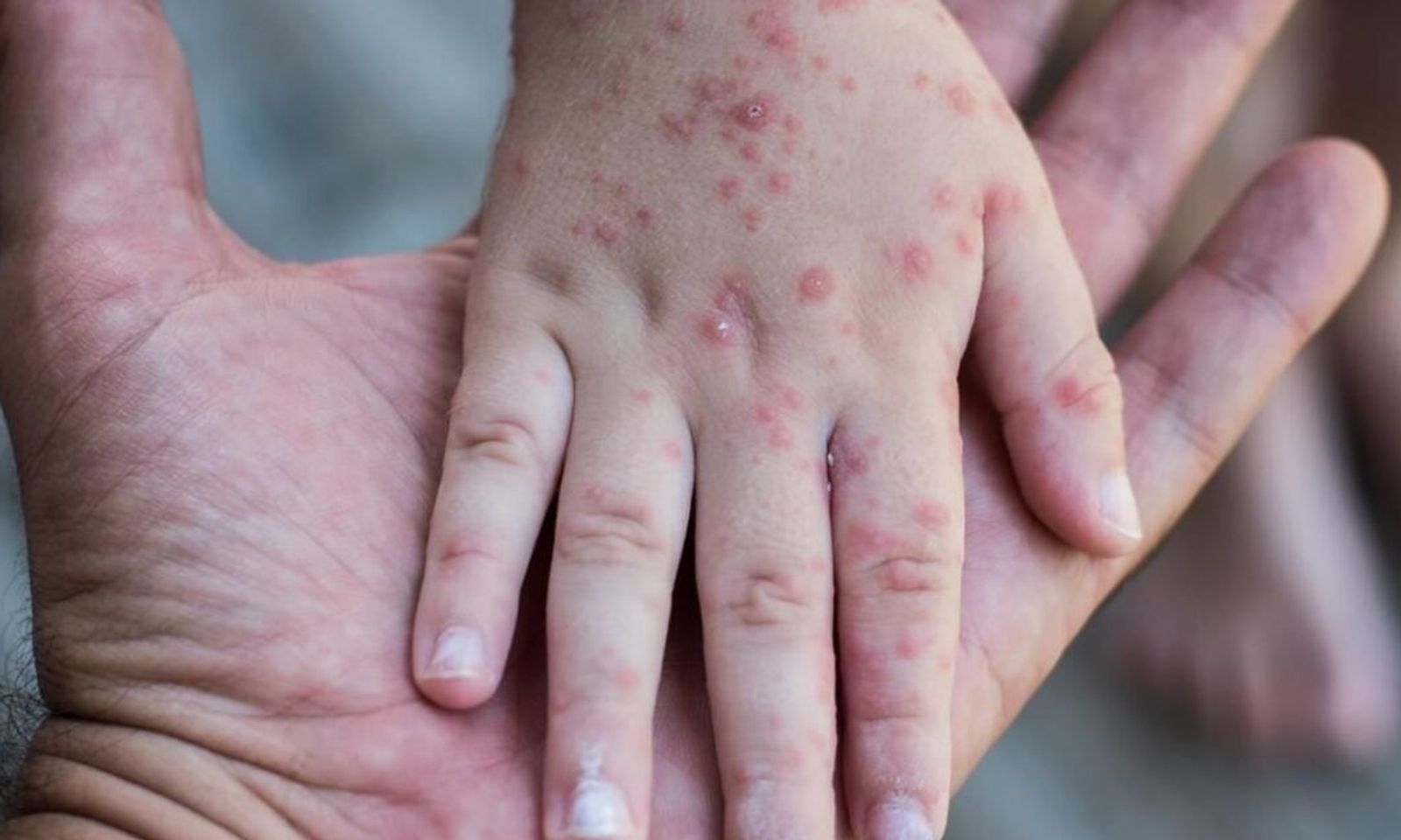 Казакстанда кызамык менен ооругандар 17 миңден ашты