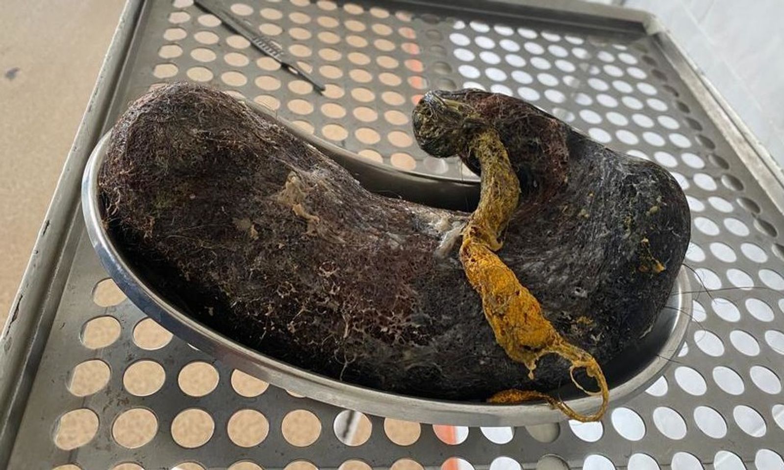 Бишкекте 18 жаштагы кыздын ашказанынан 4 кг дай чач алынды