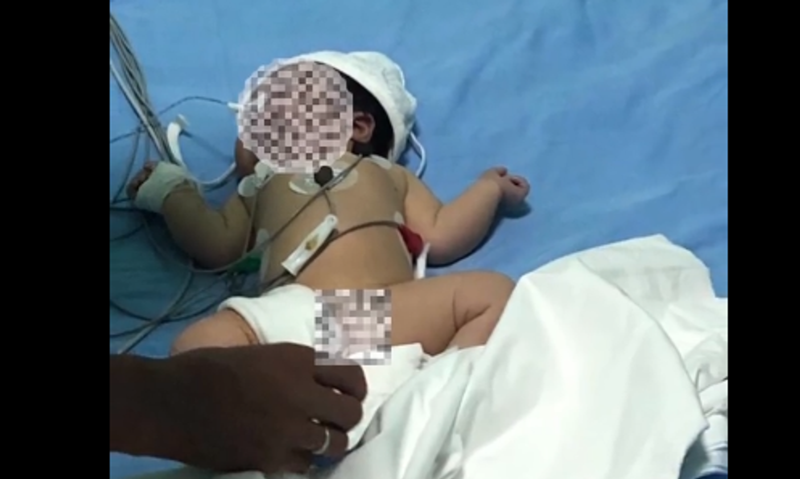 Өлкөдө эки күндүк ымыркайдын жүрөгүнө операция жасалды