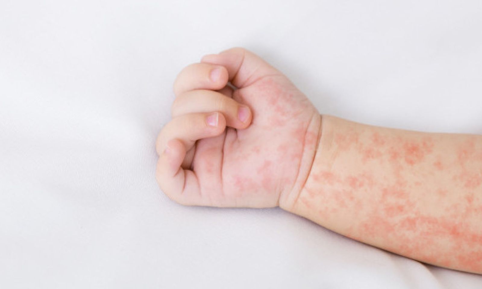 Кыргызстанда кызамыкка чалдыккандардын саны көбөйүүдө