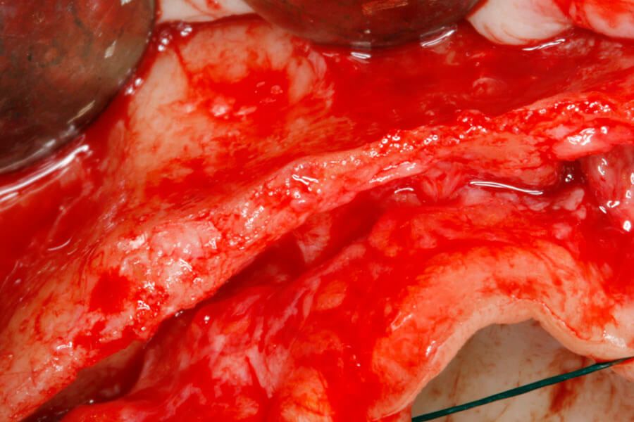 Extrem atrophierter Oberkiefer-Alveolarfortsatz