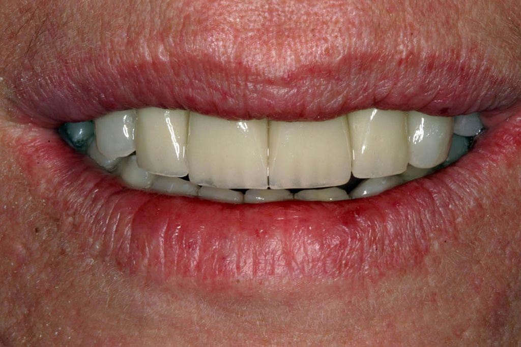 Klinischer Zustand nach Abschluss der implantatprothetischen Versorgung
