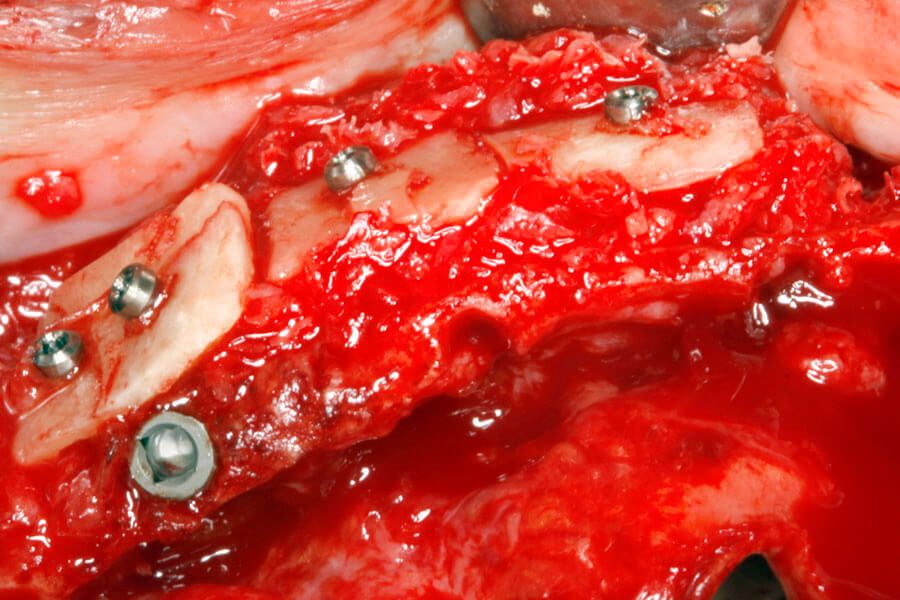 Extrem atrophierter Oberkiefer-Alveolarfortsatz