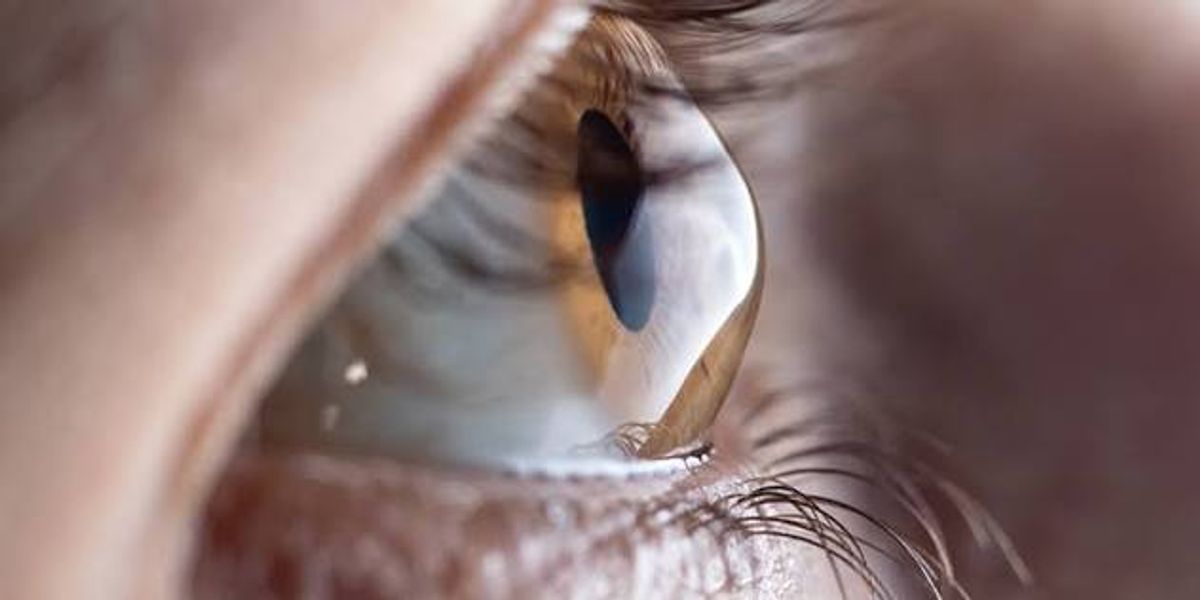 Keratoconus Treatment in Mumbai: Symptoms, Causes, Diagnosis & Modern Treatment Options