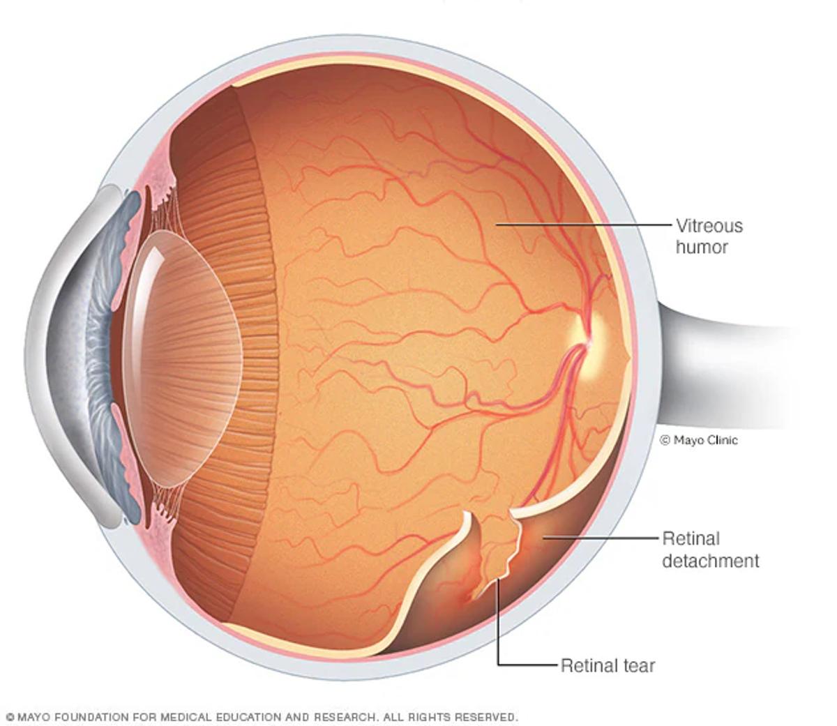 Retinal Detachment: Symptoms, Causes, Risk Factors & Treatment