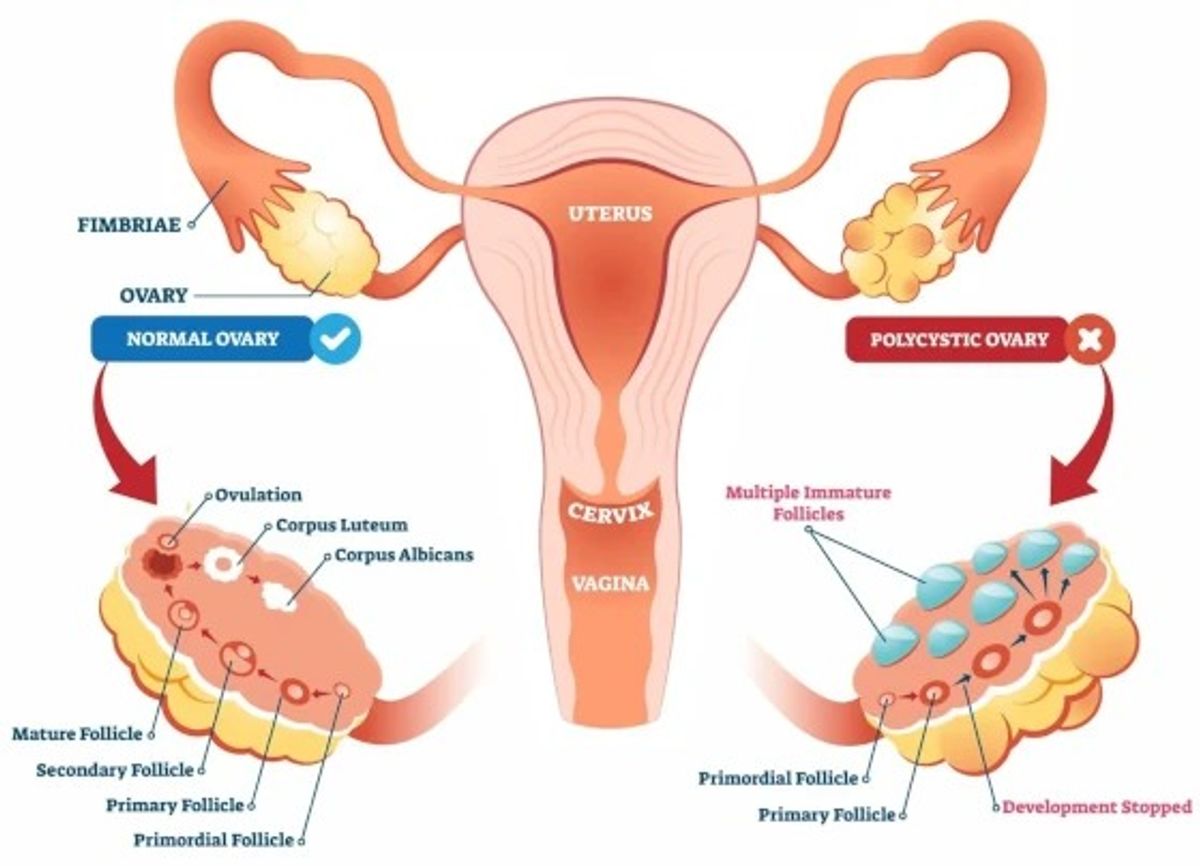 PCOS vs PCOD: What's the Difference? A Complete Guide