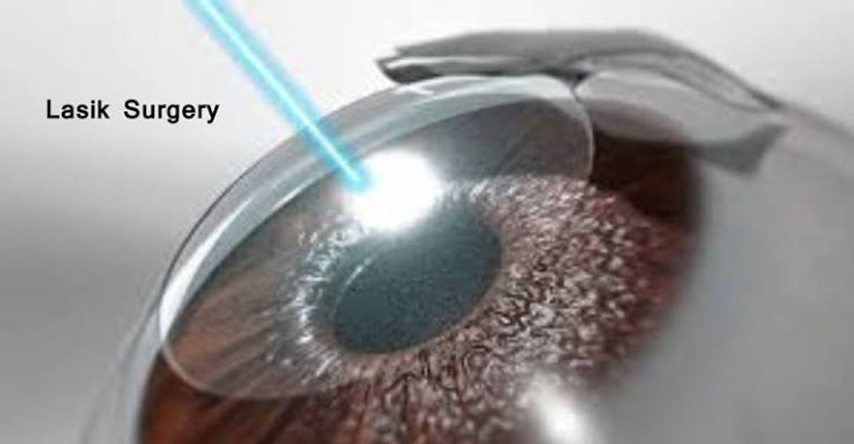 LASIK Eye Surgery in Mumbai: Eligibility, Procedure, Benefits & Recovery