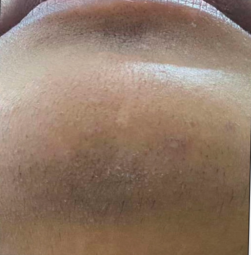 Facial hair removal (Chin)
