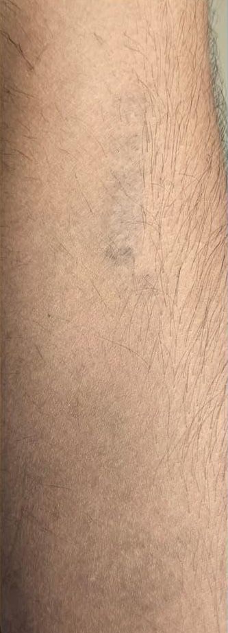 Tattoo Removal Results