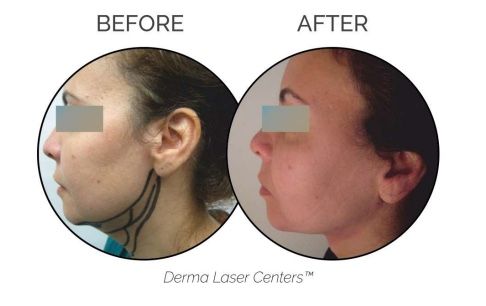 Microlift Treatment overview