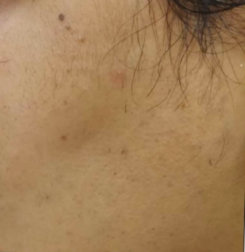 Facial hair removal (Sidelocks)