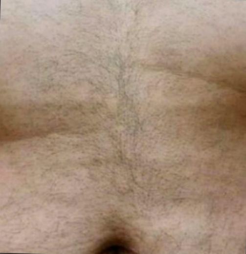  Body hair removal 