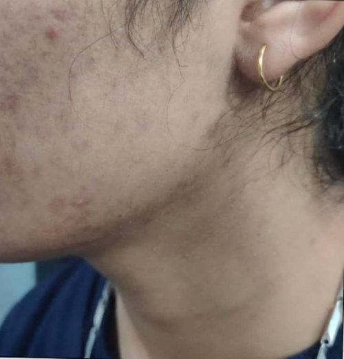 Facial hair removal (Sidelocks)
