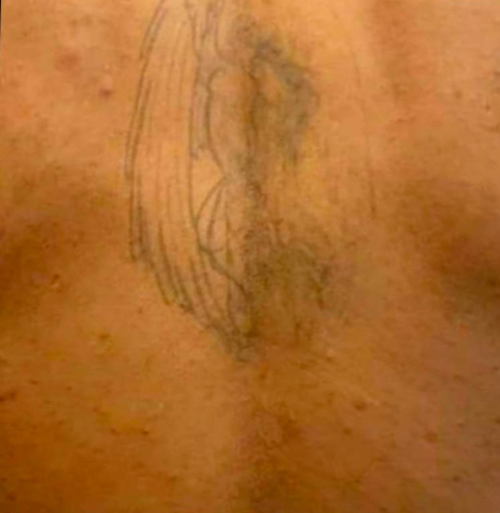 Body hair removal (Back)