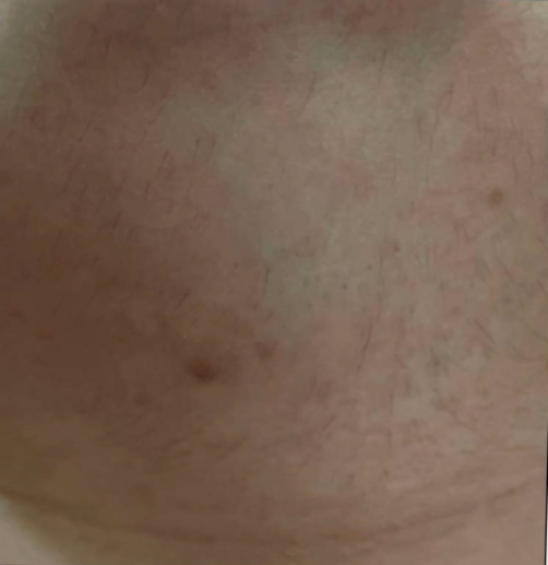 Facial hair removal (Chin)