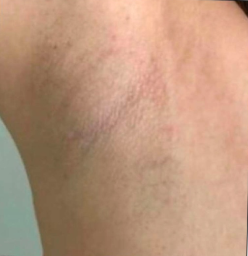 Body hair removal (Under Arms)