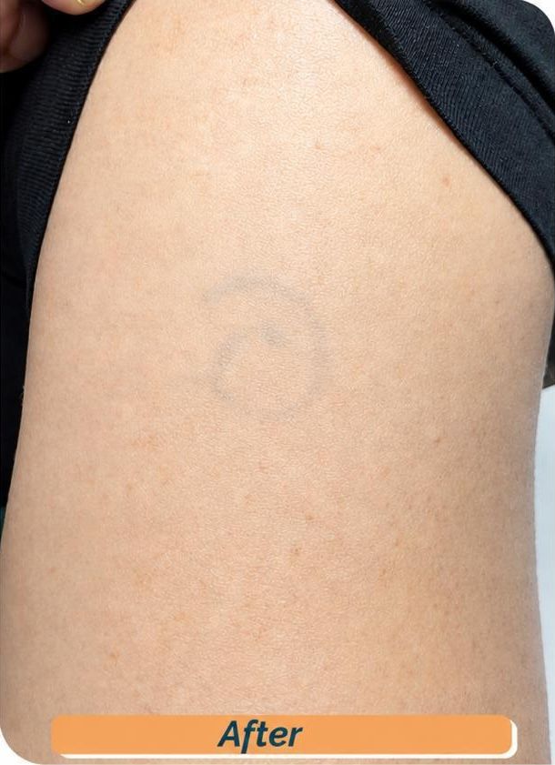 Tattoo Removal Result