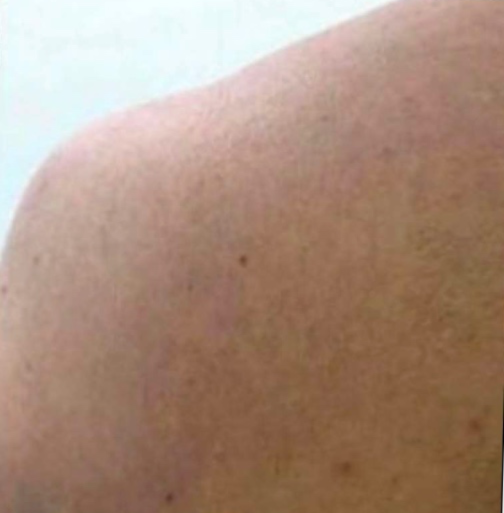 Facial hair removal (Back)