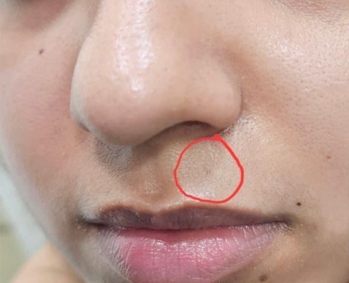 Tattoo Removal Results