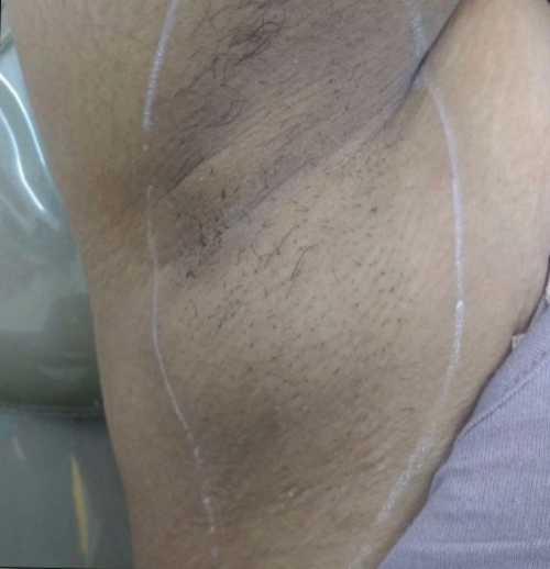 Body hair removal (Under Arms)