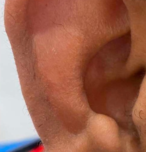 Body hair removal (Ear)