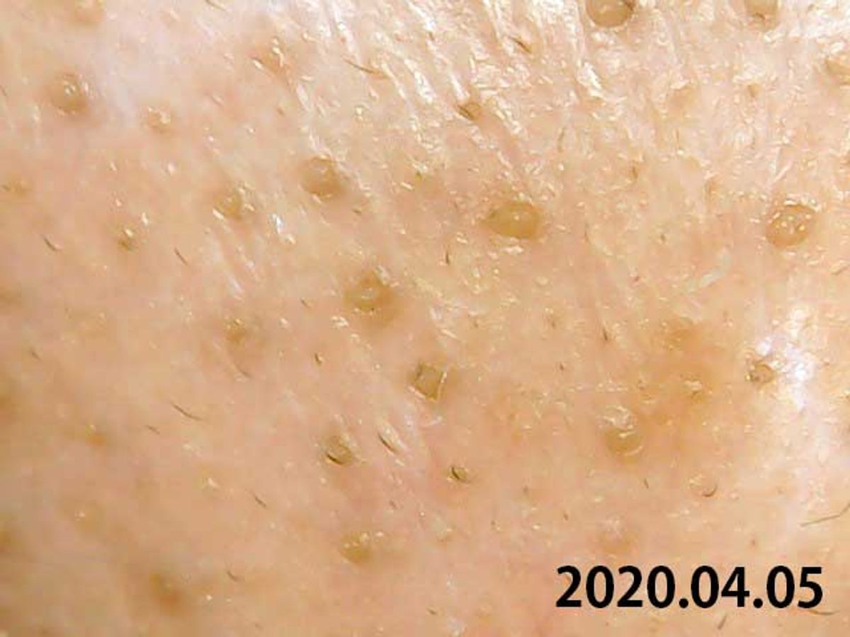2020年4月5日の鼻の頭の様子