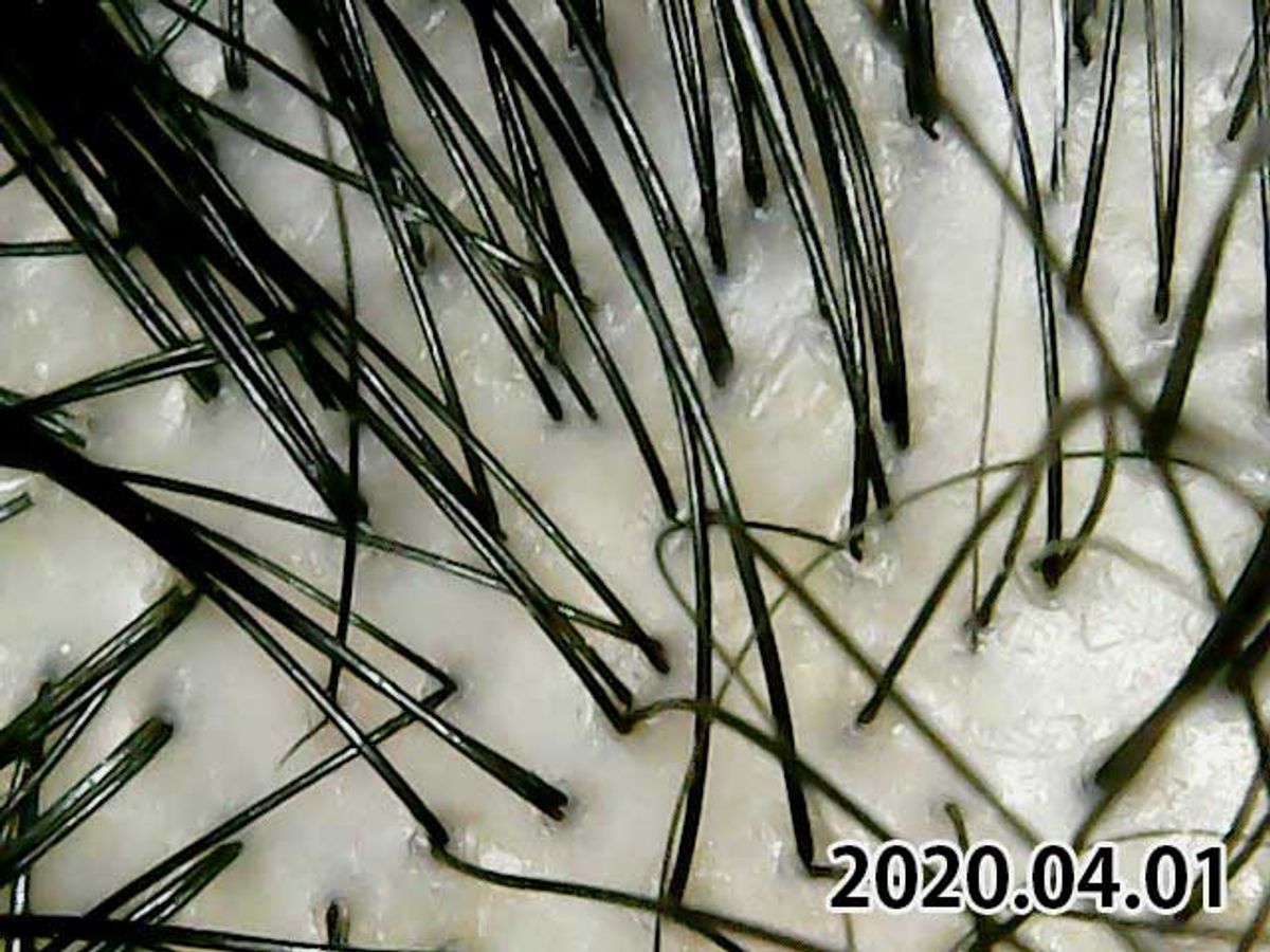 2020年4月1日頭皮の状態