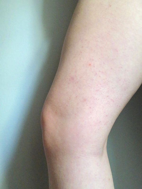 Keratosis Pilaris Soft Services the body skin experts