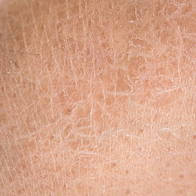 Example of dry skin from hard water effects