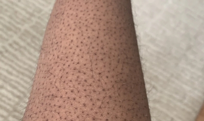 Strawberry skin on leg