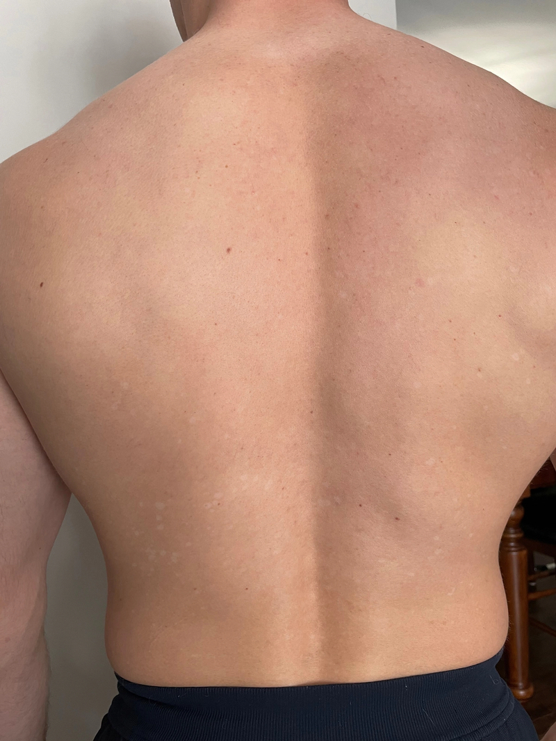 Tinea Versicolor Gallery—Pictures on Back, Chest, Butt Soft Services