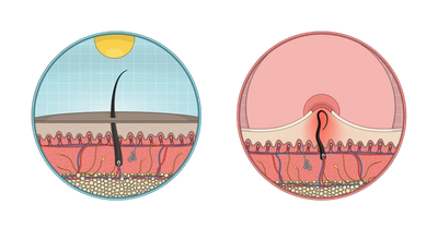 Illustration of a normal hair (left) and an ingrown hair (right)