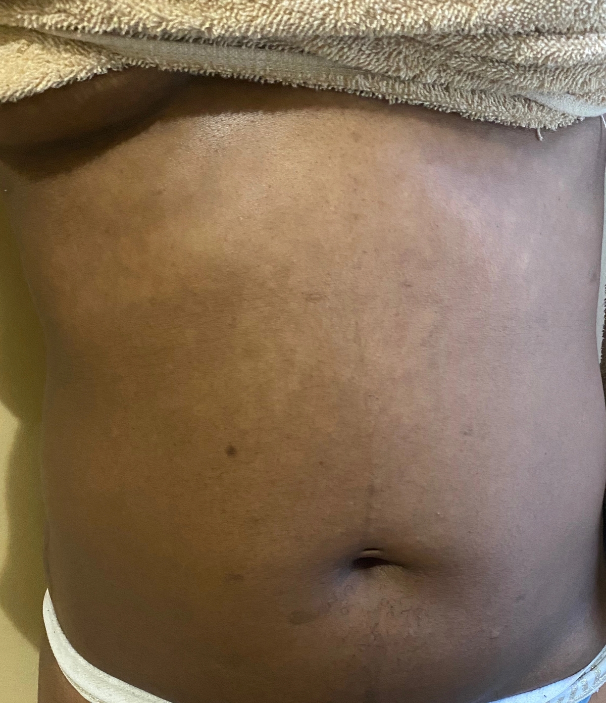 Tinea Versicolor Gallery—Pictures on Back, Chest, Butt | Soft Services ...