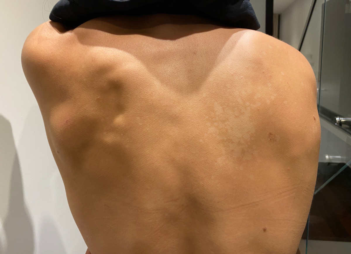 Tinea Versicolor Gallery—Pictures on Back, Chest, Butt | Soft Services ...