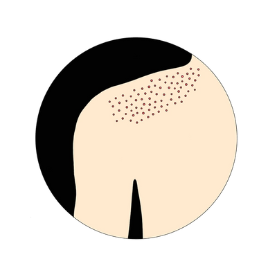 Illustration: Fungal “acne” will look uniform; all the bumps will be around the same size.