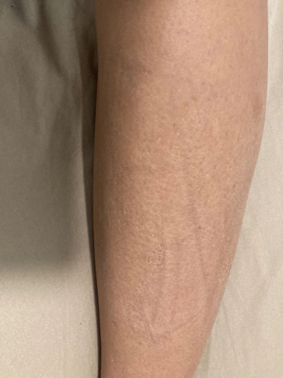 skin hardening on legs