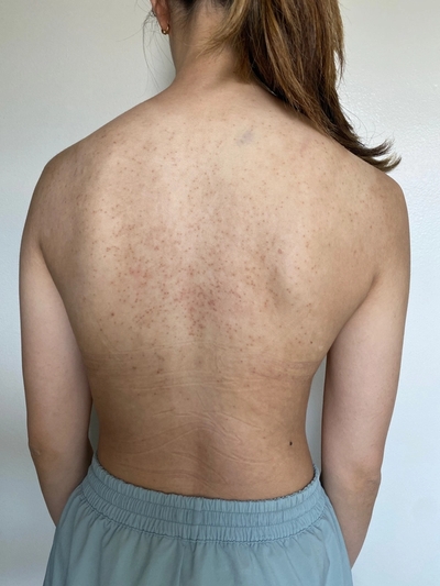 female chest acne