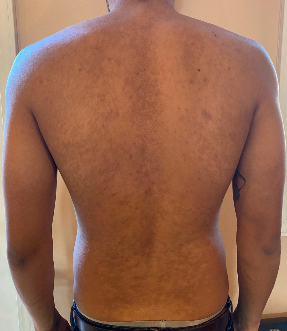 Tinea Versicolor Gallery—Pictures on Back, Chest, Butt | Soft Services ...