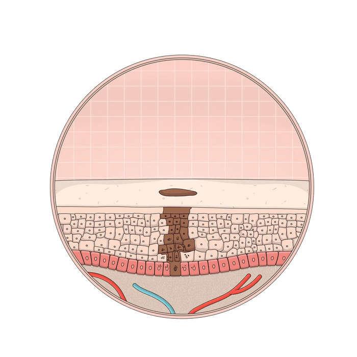 Tinea versicolor Information